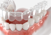 Invisalign at Aura Specialized Center – Your Smile, Our Priority