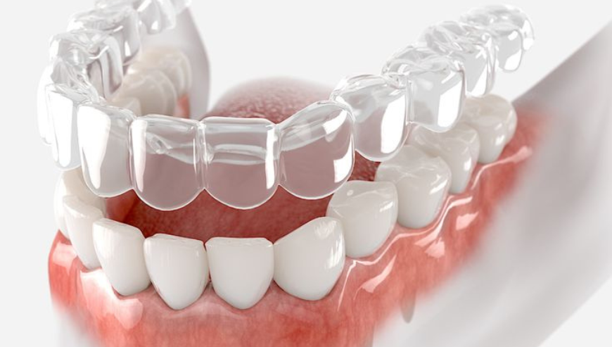 Invisalign at Aura Specialized Center – Your Smile, Our Priority