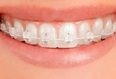 Invisalign at Aura Specialized Center – Your Smile, Our Priority