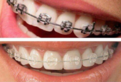 Invisalign at Aura Specialized Center – Your Smile, Our Priority
