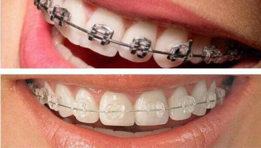 Invisalign at Aura Specialized Center – Your Smile, Our Priority